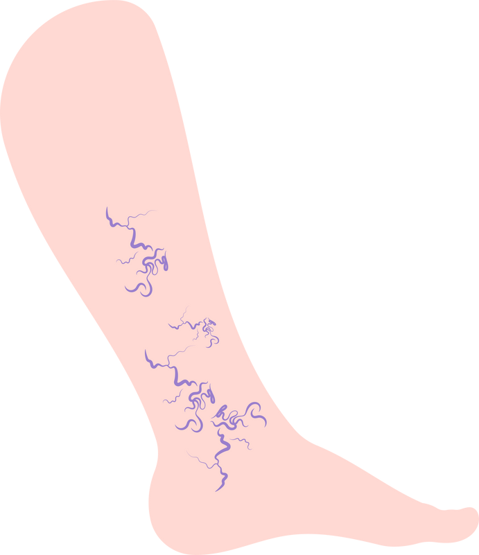 ischemia compartment syndrome Calf